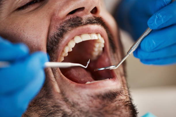 Best Emergency Wisdom Tooth Extraction in Six Mile, SC